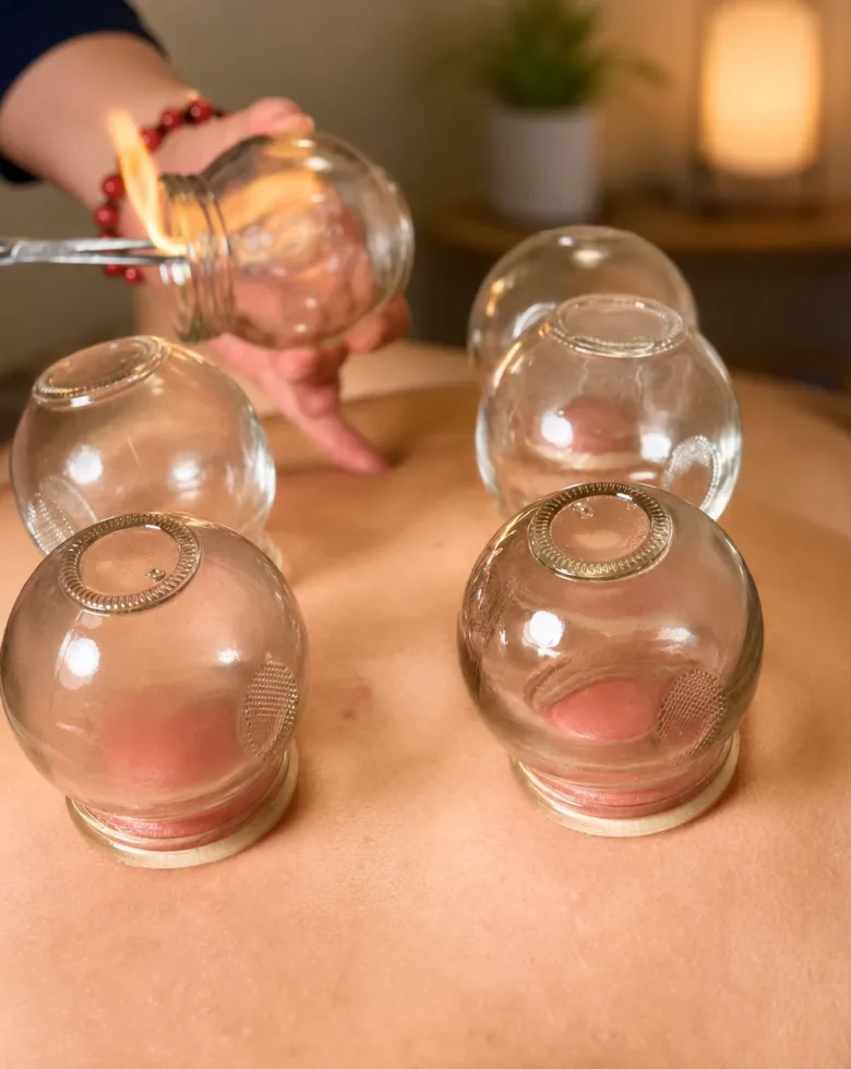 Fire cupping therapy
