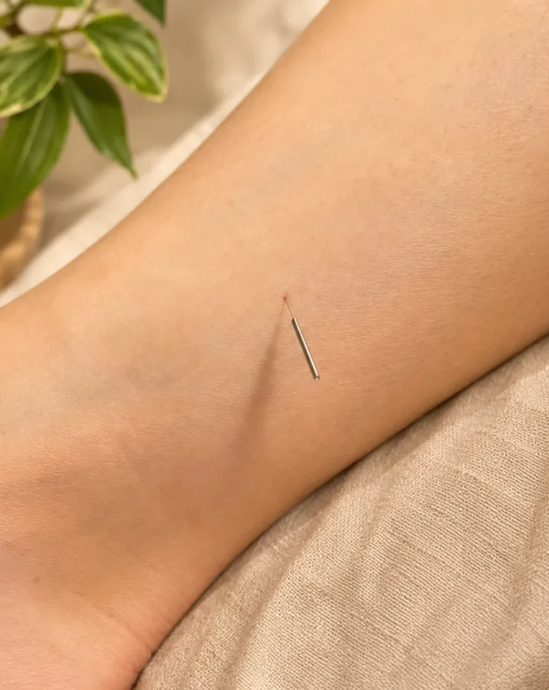 Acupuncture treatment for women's health